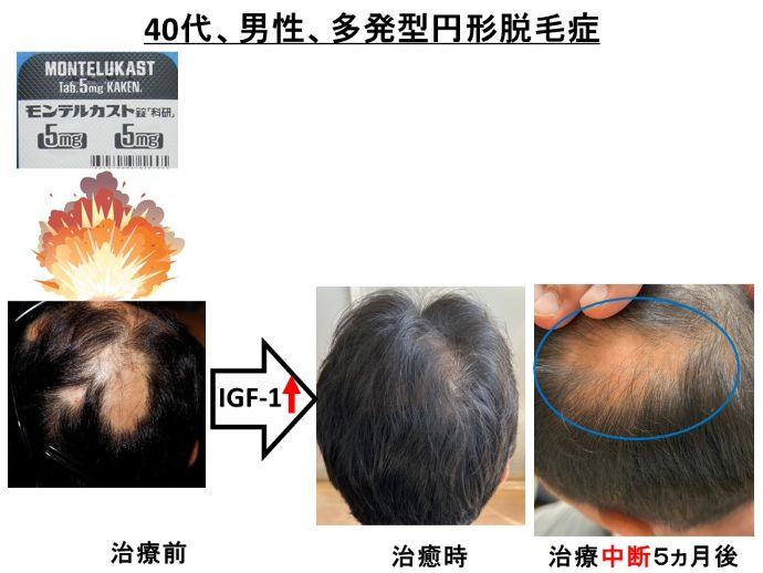 円形脱毛症　病院